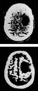图6 神经胶质瘤患者头部的核磁共振断面像(上)和X射线断层像(下)