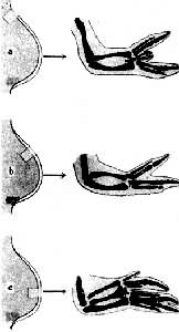 图3　肢芽极化区的移植实验　a 移植在前部 b 移植部位向中部移动 c 移植在中部