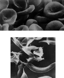 图4 正常红细胞(a)和镰刀状贫血症的红细胞(b)