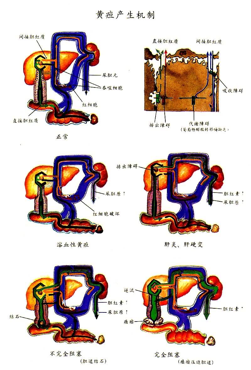 黄疸产生机制