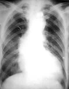 梅毒性心脏病的X射线所见：心脏呈“主动脉型”