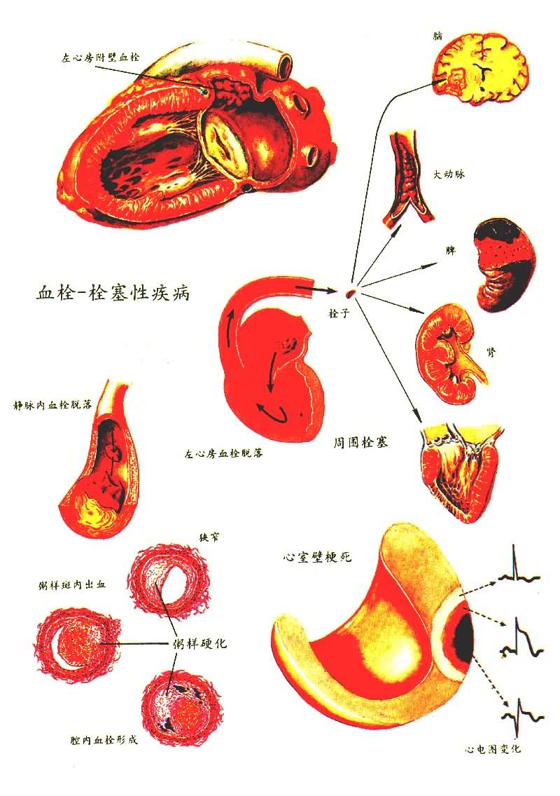 血栓-栓塞性疾病