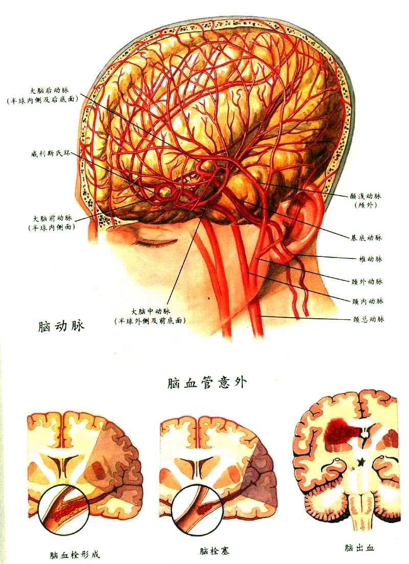 脑动脉和脑血管意外