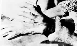 日本群马县安中市镉中毒受害者的畸形手指